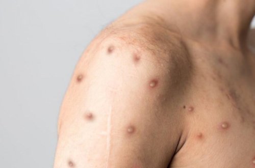 Meymunçiçəyi xəstəsi danışdı: COVID-19-dan 100 dəfə...