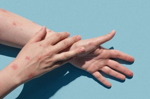 San-Fransiskoda meymunçiçəyi ilə bağlı fövqəladə vəziyyət elan edildi