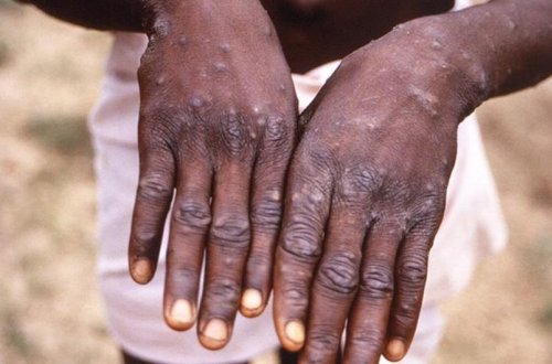 İspaniyada meymunçiçəyindən ilk ölüm qeydə alınıb