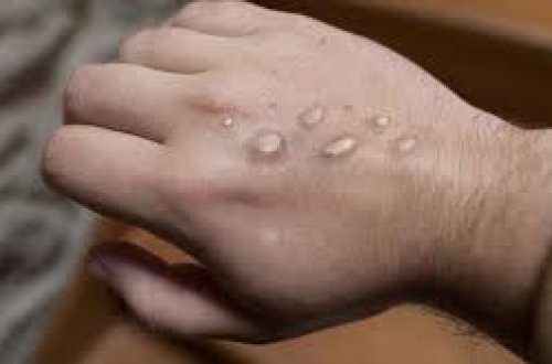 В Германии оспой обезьян впервые заразились подростки