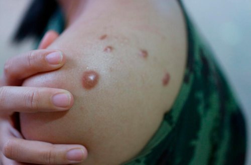 TƏBİB meymunçiçəyindən qorunmağın üsullarını açıqladı