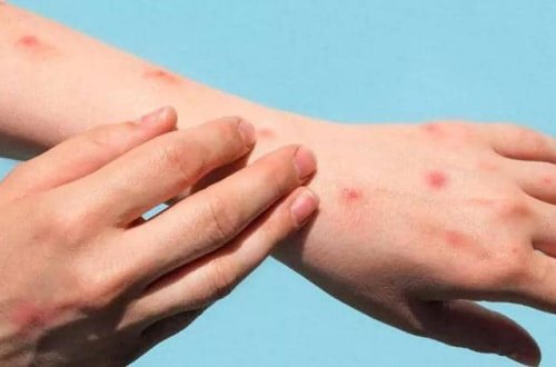 Almaniyada 4 yaşında uşaqda meymunçiçəyi aşkarlandı