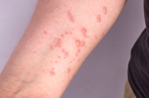 Daha bir ölkədə meymunçiçəyinə ilk yoluxma qeydə alınıb