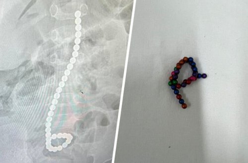 Rusiyada yaş yarımlıq uşağın bağırsaqlarından 34 maqnit çıxdı