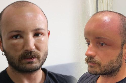 Çimərliyə gedən kişinin başına iş gəldi