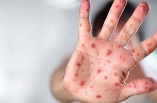 ABŞ-da meymunçiçəyindən ilk ölüm qeydə alınıb