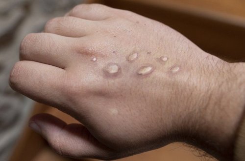 Belçikada meymunçiçəyindən ilk ölüm qeydə alınıb