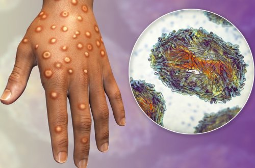 Azərbaycanda meymunçiçəyinə yoluxma faktı qeydə alınmayıb