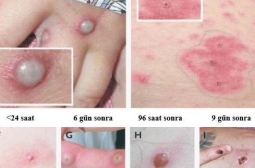 Misirdə meymunçiçəyi virusuna ilk yoluxma halı qeydə alınıb