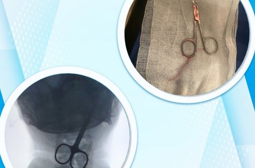 Bakı sakini qayçı udub - FOTO