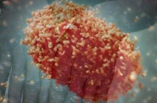 ABŞ-da meymun çiçəyi virusundan ilk ölüm halı açıqlanıb