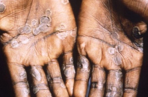 Çexiyada meymunçiçəyinə ilk yoluxma qeydə alınıb