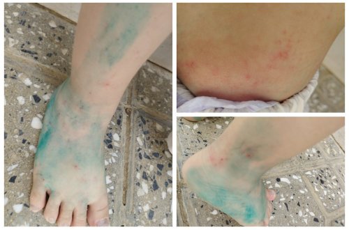 TƏBİB: Sığınacaq mərkəzində uşaqlar arasında yayılan dəri xəstəliyi qotur deyil