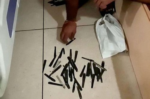 Mədəsindən 63 qaşıq çıxdı