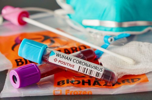 Son sutkada Azərbaycanda 81 nəfər koronavirusa yoluxub