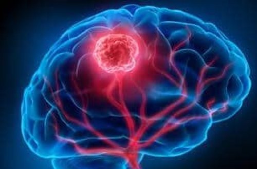 Beyin xərçənginə qarşı yeni implant: Hər il 200.000 ölümün qarşısı alına bilər