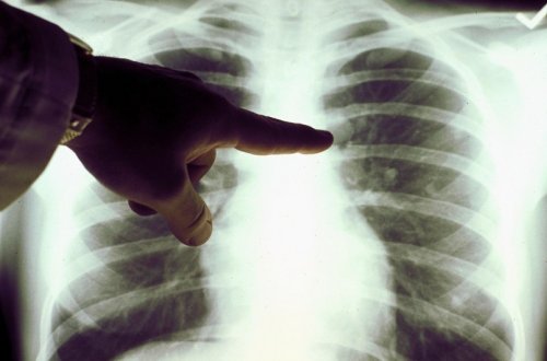 Pnevmoniyanın əsas əlamətləri açıqlanıb