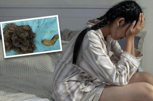 14 yaşlı qız saçlarını yeyib, bağırsaqları tüklə tıxanıb