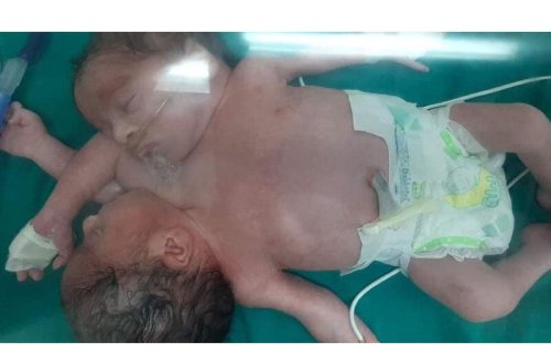 Dörd qollu bitişik əkizlər doğuldu