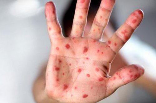 14 yaşlı yeniyetmə qızılcadan ölübmüş