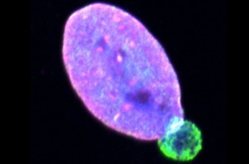 Həkimlər dəri xərçənginin bütün bədənə yayılmasına kömək edən zülal aşkar ediblər