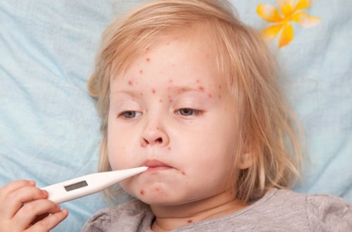 Qızılcaya yoluxmada kəskin artım var - ÜST