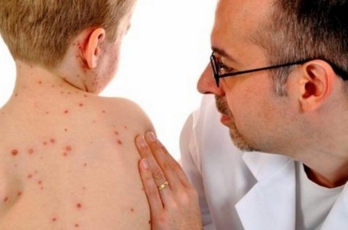 Число зараженных корью в Армении увеличилось до 46