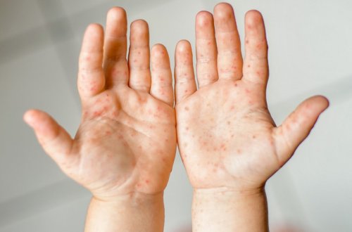 Şöbə müdiri: “Son zamanlar uşaqlar arasında bəzi dəri xəstəlikləri artıb”