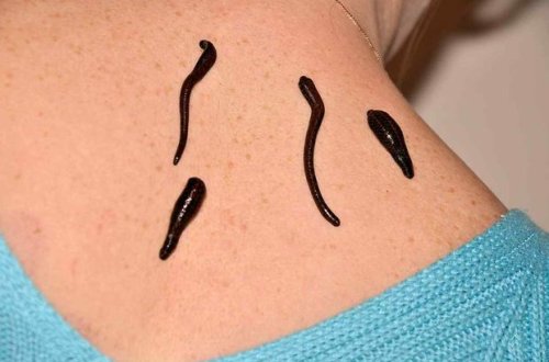 Rusiyalı alimlər: “Zəli infarkt və insultun qarşısını alır”