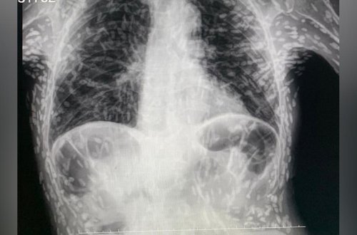 Öskürək tutması ilə xəstəxanaya getdi, mədəsindən yüzlərlə qurd çıxarıldı