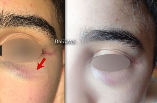 Bakı məktəbində sinif yoldaşları məktəbli qızı vəhşicəsinə döydülər - FOTO/VİDEO