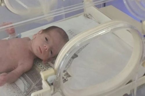 Azərbaycanda 845 qramlıq körpə doğulub - Video