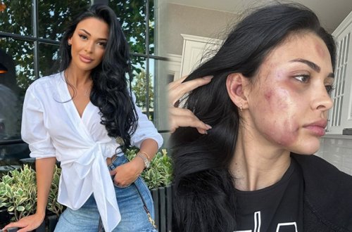 Azərbaycanlı model sevgilisi tərəfindən döyüldü - Foto