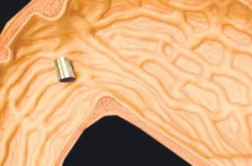 Bədəndə üzə bilən milirobot hazırlanıb