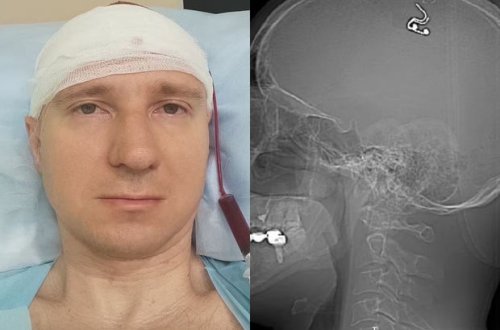 Rusiya sakini yuxularını idarə etmək istədi: Drellə beynini deşərək elektrod yerləşdirdi - FOTO