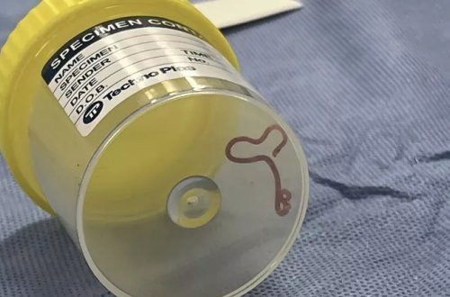 Avstraliyada ilk dəfə insan beynindən 8 santimetrlik qurd çıxdı