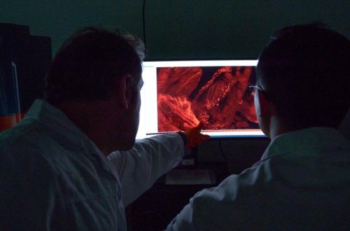 Dünyada 50 yaşdan aşağı xərçəngdən ölənlərin sayı durmadan artır - YENİ ARAŞDIRMA