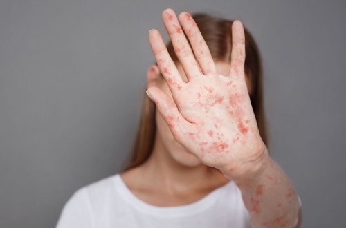 Bu il Azərbaycanda qızılca xəstəliyinə 24 yoluxma faktı aşkarlanıb