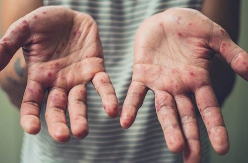 Ermənistanda qızılcaya yoluxanların sayı artır