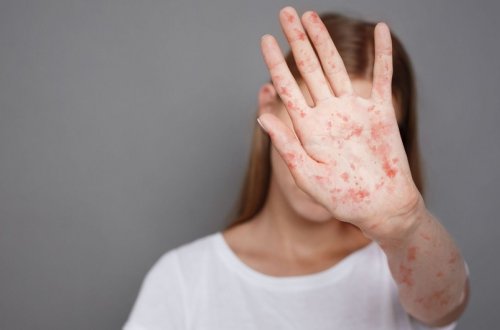 Səhiyyə Nazirliyi qızılca xəstəliyi ilə bağlı vətəndaşlara müraciət edib