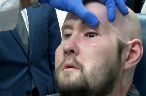 Nyu Yorkda dünyanın ilk göz transplantasiyası əməliyyatı həyata keçirildi