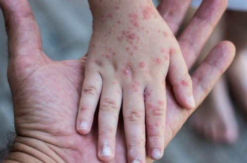 Zaqatalada qızılcaya yoluxanların son durumu açıqlanıb