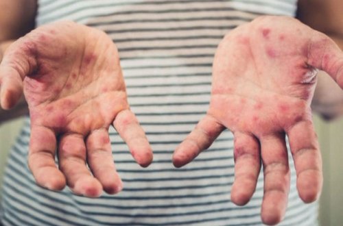 Cəlilabadda 10 tələbə qızılcaya yoluxdu