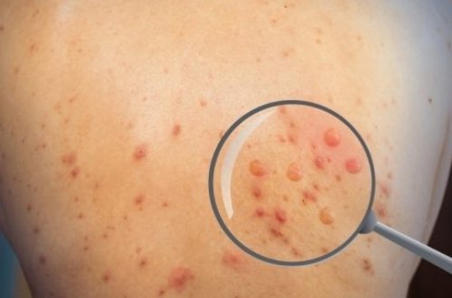 ÜST: 2022-ci ilin əvvəlindən dünyada meymunçiçəyinə 92 min yoluxma aşkarlanıb