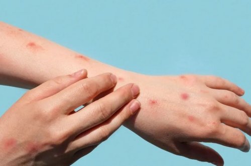 В семи школах Кюрдамира выявлены случаи заражения корью среди учащихся