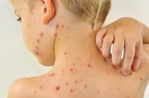 Bu il Azərbaycanda 284 nəfər qızılcaya yoluxub