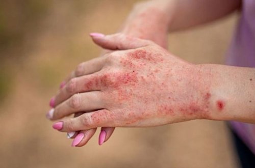 Qızılcaya yoluxanlara antibiotik vurmaq olmaz - RƏSMİ