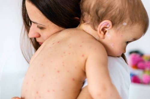 Ermənistanda qızılcaya yoluxanların sayı 513-ə çatıb