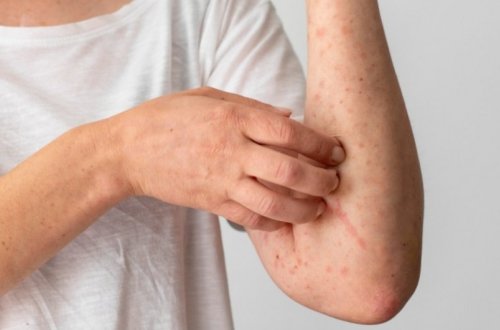 В Румынии объявили эпидемию кори