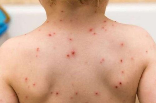 Qızılca xəstəliyinin yaratdığı fəsadlar açıqlanıb